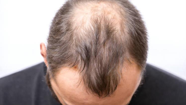 Is Finasteride Useless For Hair Loss?